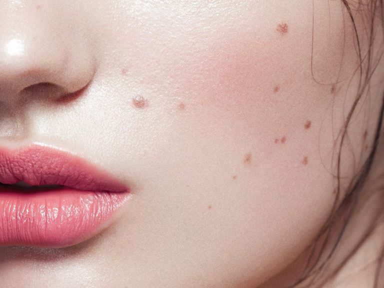 Cara Membedakan Tahi Lalat Normal Dan Kanker Kulit Panduan Lengkap Untuk Deteksi Dini