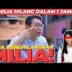 Cara Menghilangkan Milia Di Area Mata Secara Natural Panduan Lengkap Dan Aman