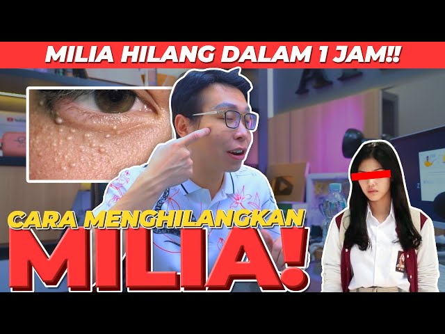 Cara Menghilangkan Milia Di Area Mata Secara Natural Panduan Lengkap Dan Aman