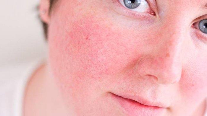 Pentingnya Menjaga Skin Barrier Agar Tidak Rusak Kunci Kulit Sehat Dan Terlindungi